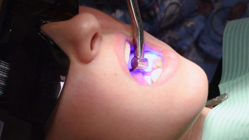 Composite Fillings Littleton