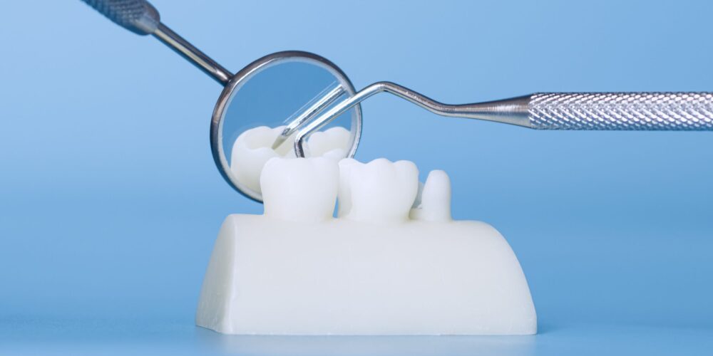 Dental Bridges Littleton