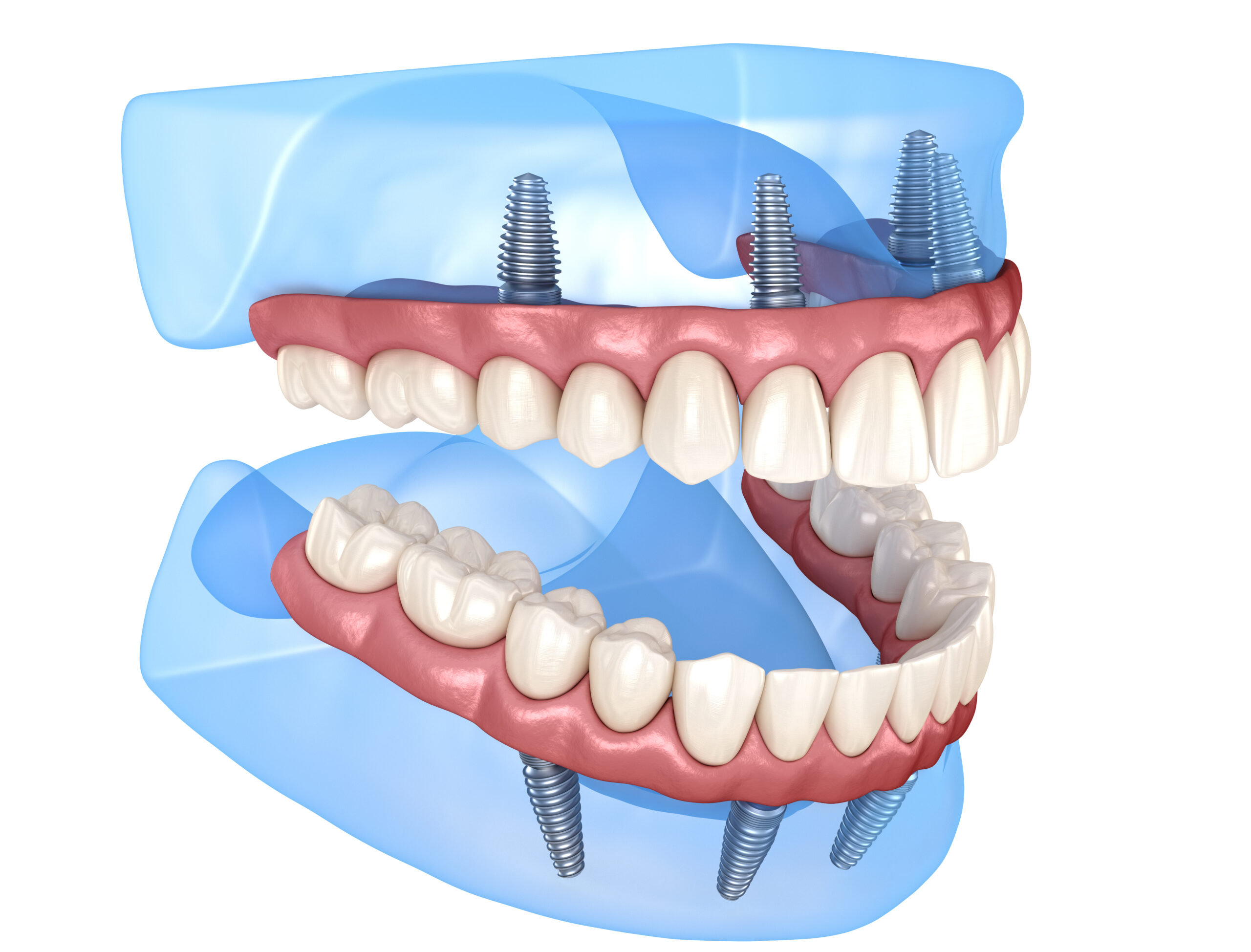 Implant-Supported Dentures Littleton